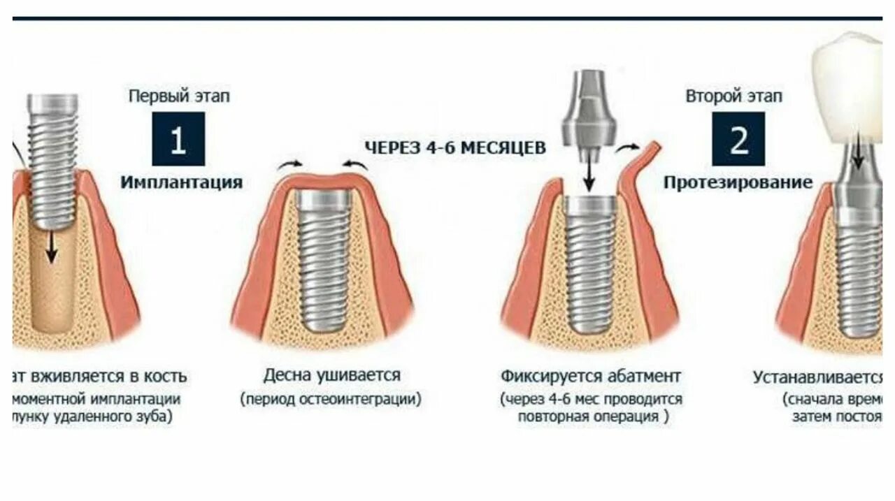 Этапы стоматологической имплантации. Схема установки зубного импланта. Схема установки стоматологических имплантов. Этапы имплантации формирователь. Насколько плотно