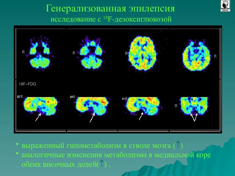 Позитронно-эмиссионная томография. Позитронно-эмиссионная томография. Исследование ЦНС. Позитронно-электронная томография презентация. Позитронный распад. Исследование эпилепсии