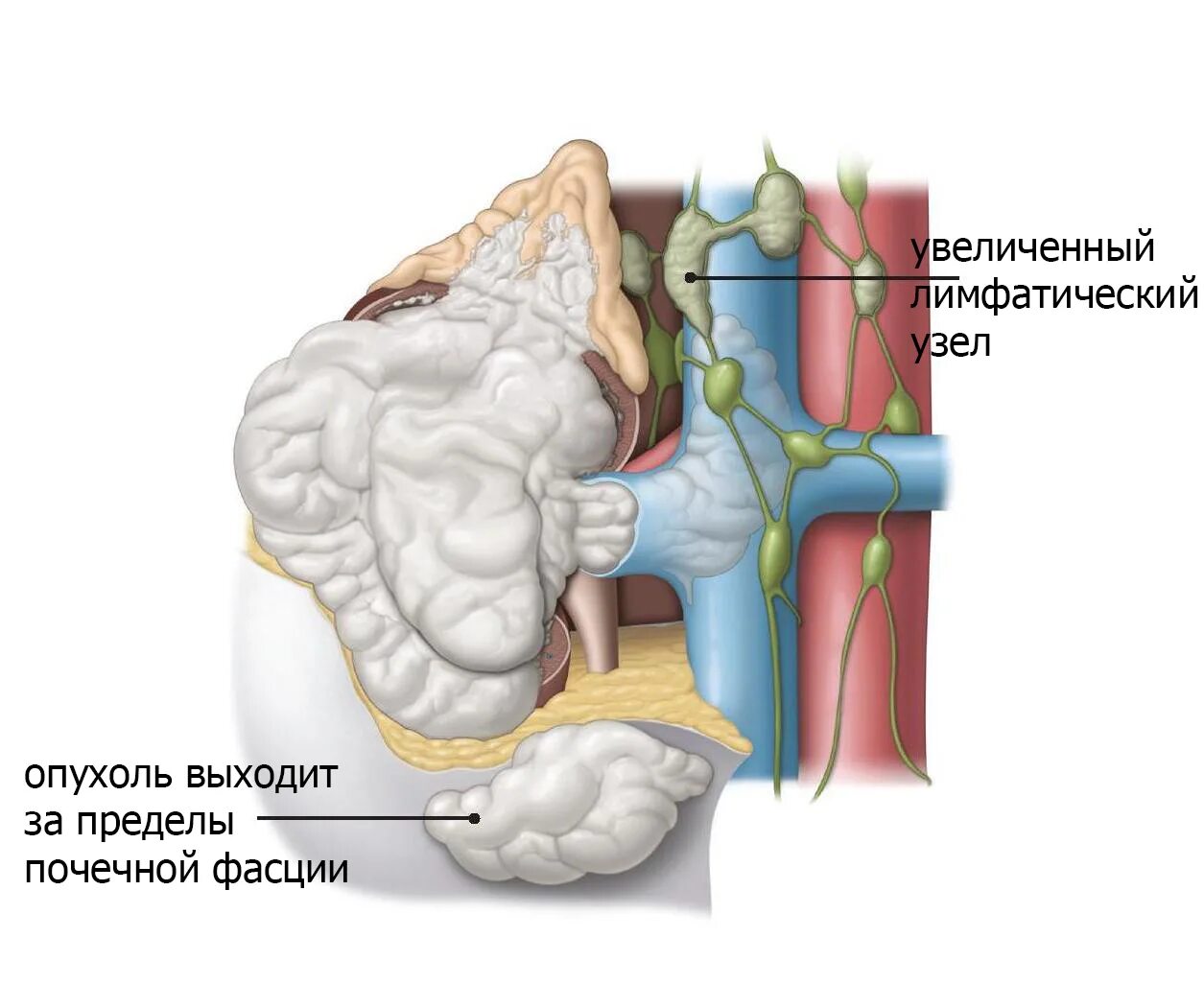 Лимфоузлы надпочечников. Лимфоузлы надпочечника. Опухоль надпочечников операция. Опухоль пучковой зоны коры надпочечника. Опухоль сетчатой зоны коры надпочечников.