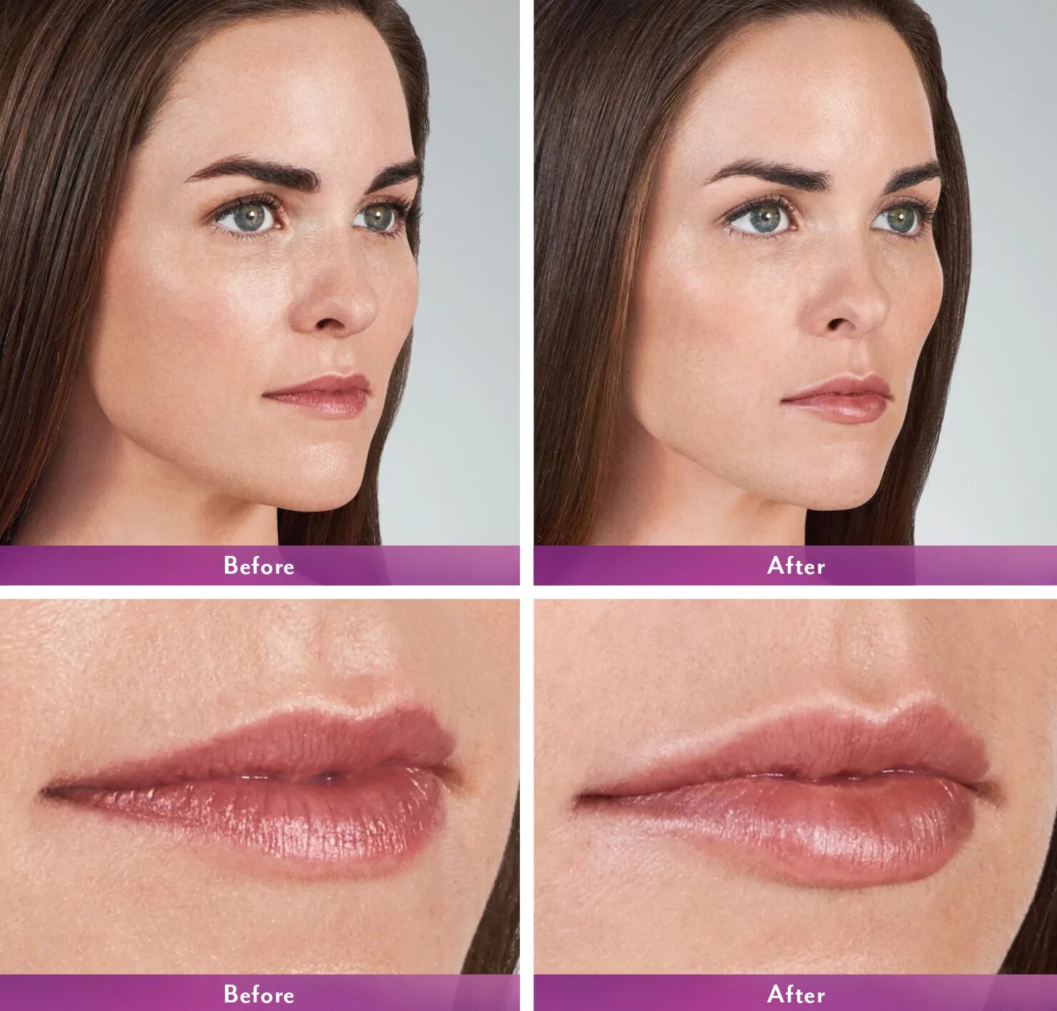 Губы после ювидерм. Voluma Juvederm губы. Ювидерм Volbella.