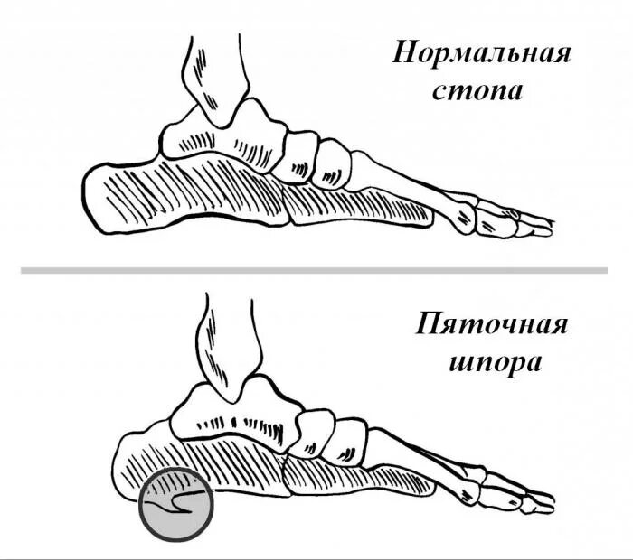 Как определить пяточную шпору
