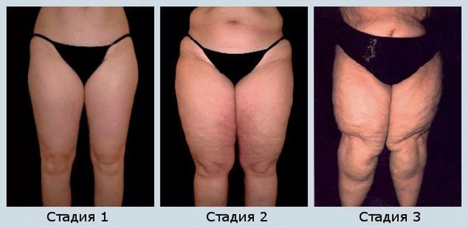 Как понять отек или жир. Как понять отек или жир. Как понять отек или жир. Как понять жир или отек. Как понять отек или жир.