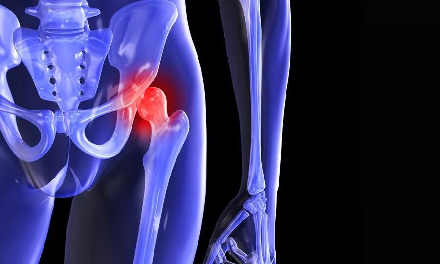 Тендиноз тазобедренного сустава. Периартрит коленных тазобедренных суставов. Лопаточно-плечевой периартрит. Гребешковый бурсит тазобедренного сустава. Периартрит тазобедренного сустава.