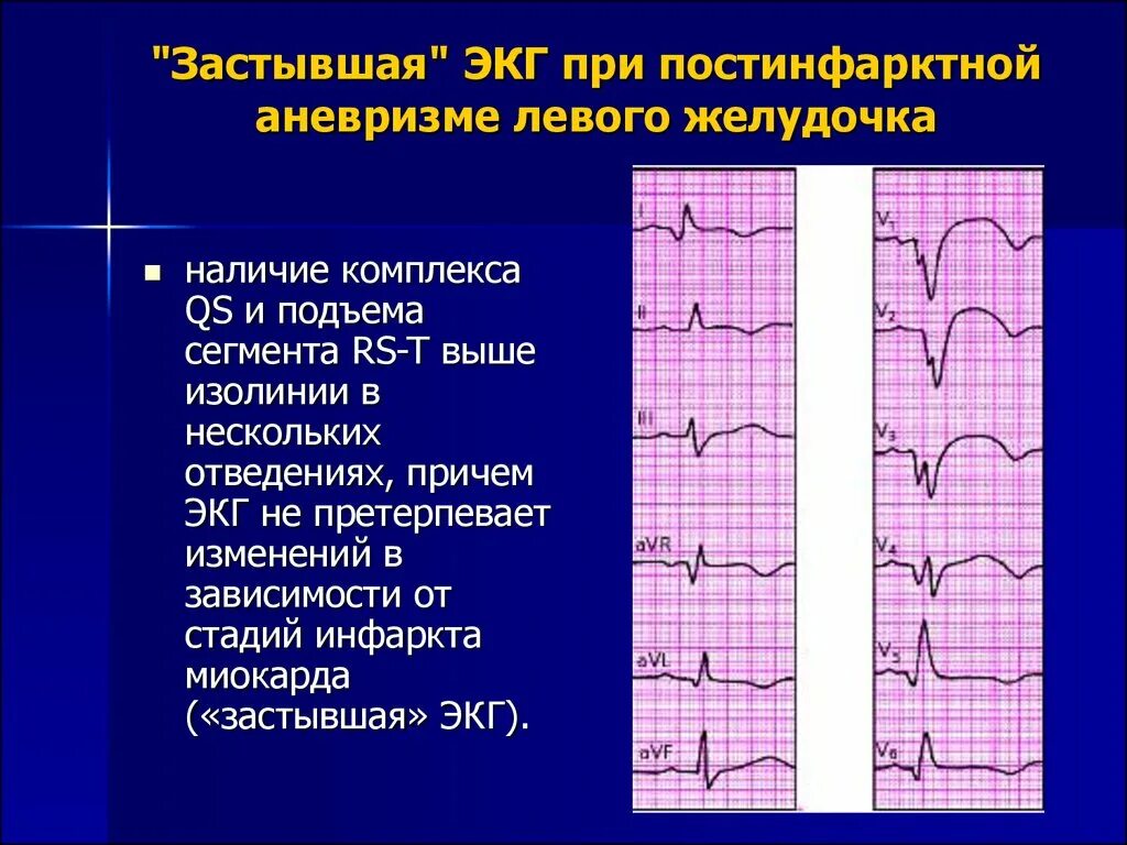 ЭКГ признаки аневризмы сердца. Инфаркт миокарда с аневризмой ЭКГ. Постинфарктная аневризма левого желудочка на ЭКГ. Аневризма левого желудочка на ЭКГ. Изменения боковых отделов