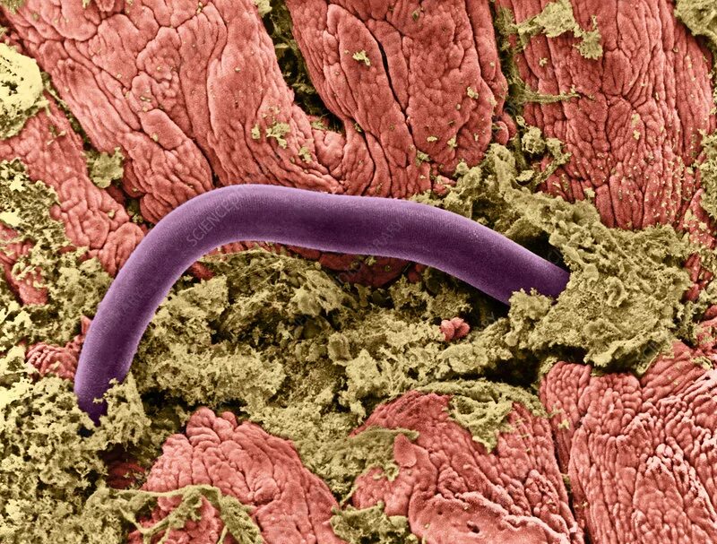 Гестационная трансформация спиральных артерий матки. Инвазия и инфекция различия. Контактный путь инвазии. Некатороз трихоцефалез. Инвазия 3.