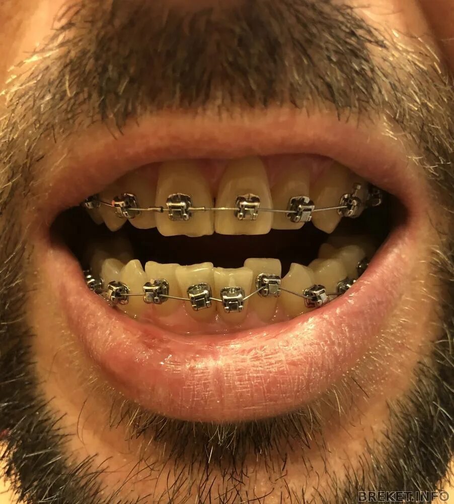 Fans of Johnny Depp believe that his "rotten teeth" look like Captain Jack Sparr
