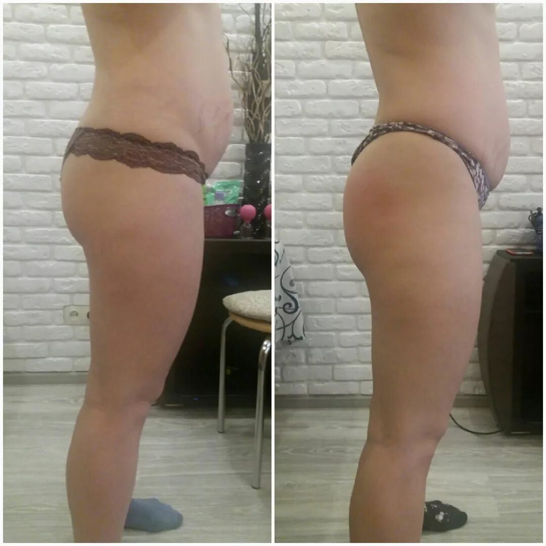 кавитация липолиз. результаты антицеллюлитного массажа. эффект после кавитации. моментальный загар до и после. диета без сладкого.