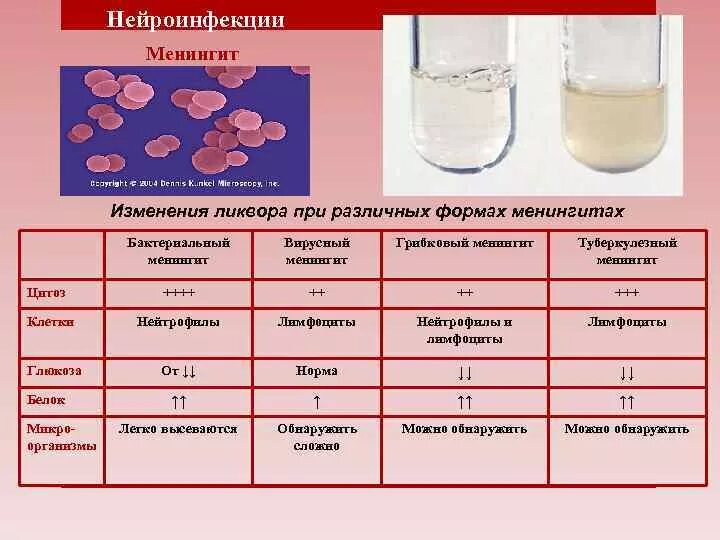 Состав спинномозговой жидкости при туберкулезном менингите. Исследование спинномозговой жидкости при Гнойном менингите. Показатели крови при менингите. Изменение ликвора при менингите.