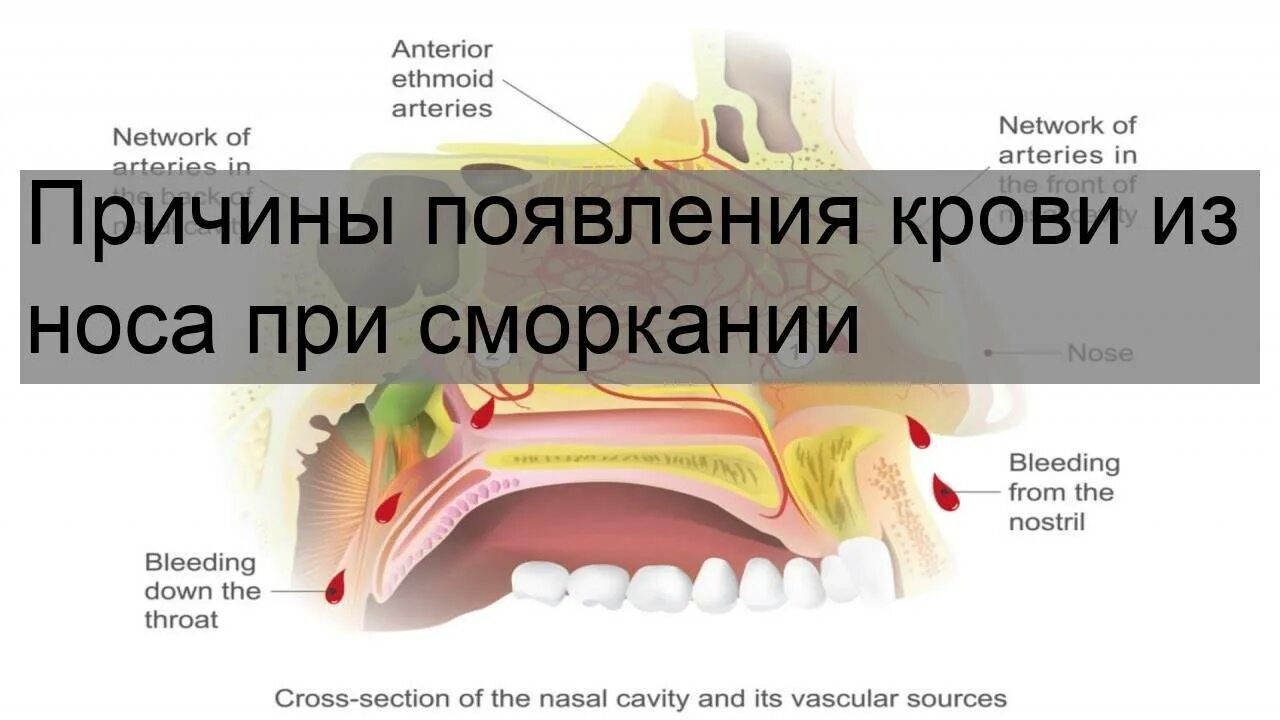 Кровь из носа при сморкании. Почему идёт кровь из носа. Почему идет кровь из носа и что делать. Идет носом кровь у беременной