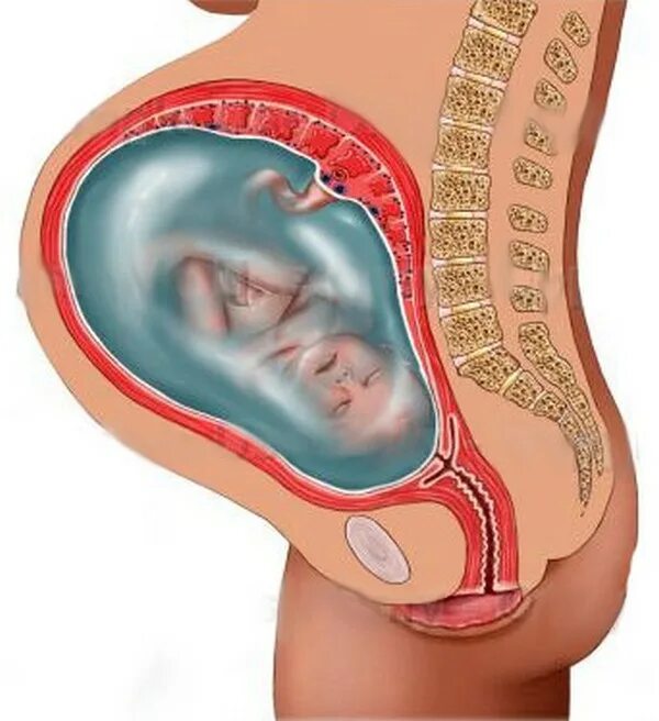 Пролабирование плодного пузыря.