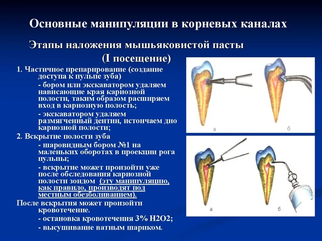 После наложения мышьяка. Этапы препарирования корневых каналов. методика наложения девитализирующей пасты. этапы (фазы) препарирования корневых каналов. этапы наложения мышьяковистой пасты.