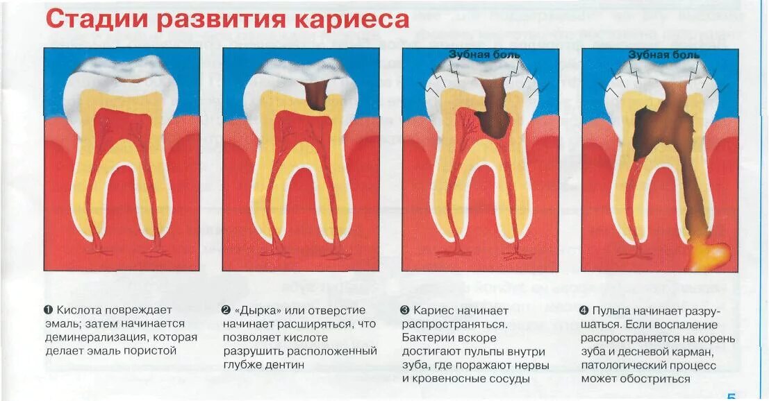 Глубокий кариес пульпит периодонтит. Механизм образования кариеса биохимия. Схему формирования очаговой деминерализации эмали. Кариес пришеечный классификация. Степени развития кариеса.