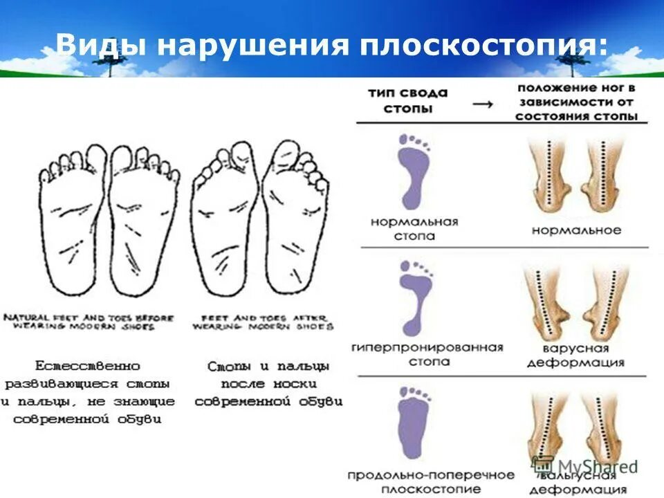 Средняя стопа. Плоскостопие вид спереди. Плоскостопие вид сбоку. Поперечное плоскостопие вид спереди. Степени плоскостопия вид сбоку.