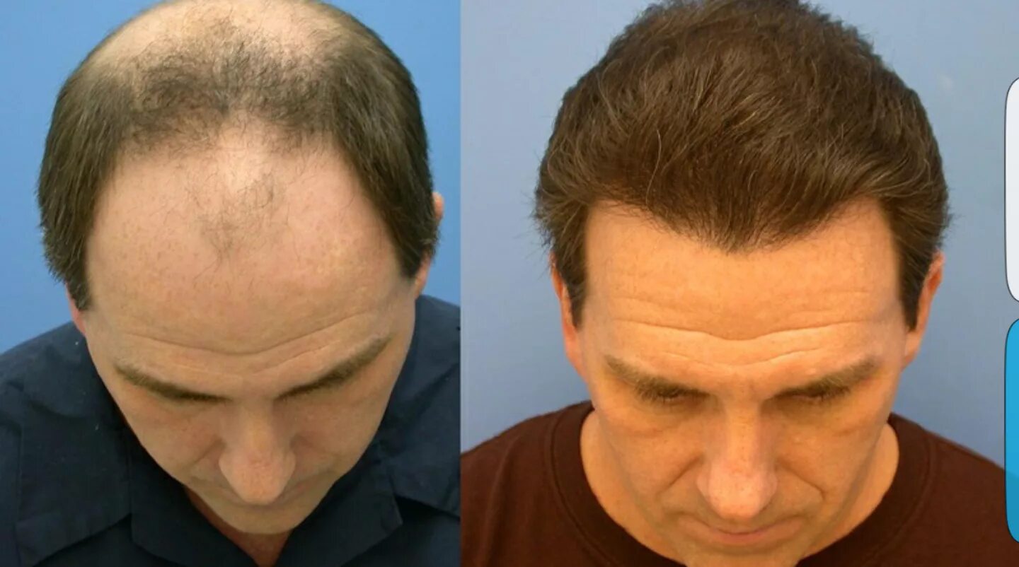 Через сколько лет пересаживают. Трансплантация волос до и после. Пересадка волос волос до и после. До и после пересадки волос мужчинам.
