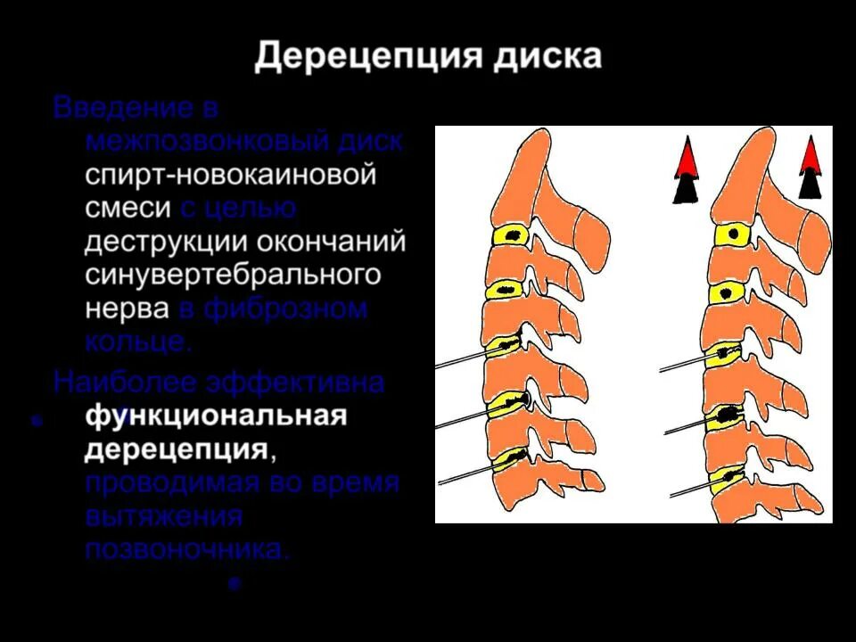 Последствия блокады позвоночника. Синувертебрального нерва Люшка. Синувертебральный нерв иннервирует. Функциональная дерецепция. Синувертебральный нерв Люшка иннервирует.