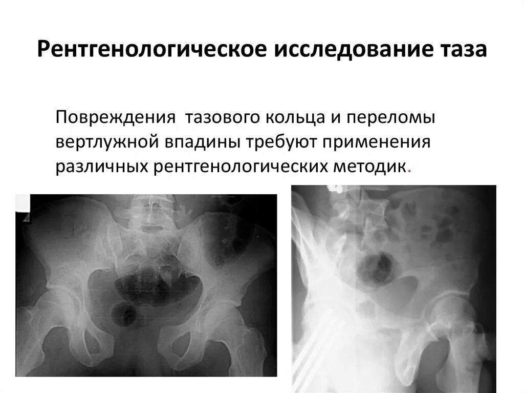 Методики лучевого исследования костей и суставов. Порядок проведения рентгенографии. Экскреторная урография рентгенологическое исследование. Традиционное рентгенологическое исследование. Обследования пациентов с ранениями.