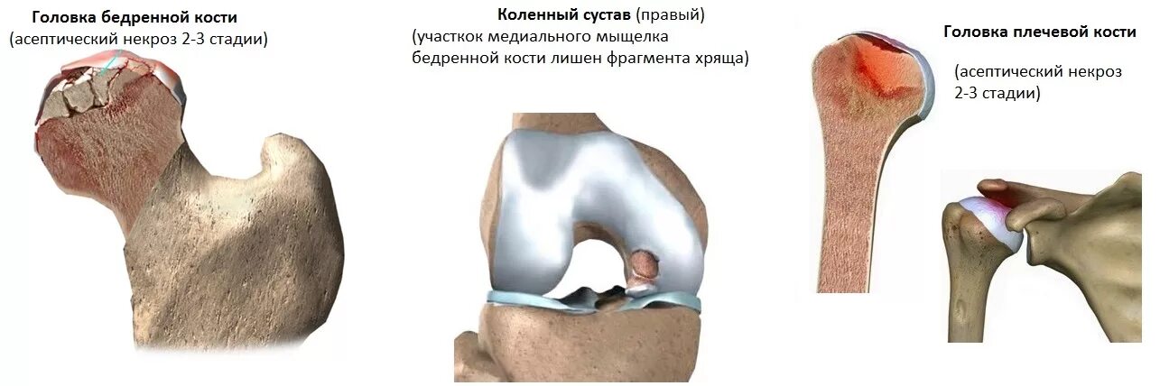 Асептический некроз мыщелков бедренной. Асептический некроз коленного сустава кт. Асептический некроз коленного сустава стадии. Асептический некроз головки мыщелка бедренной кости. Асептический некроз медиального мыщелка левой бедренной кости.