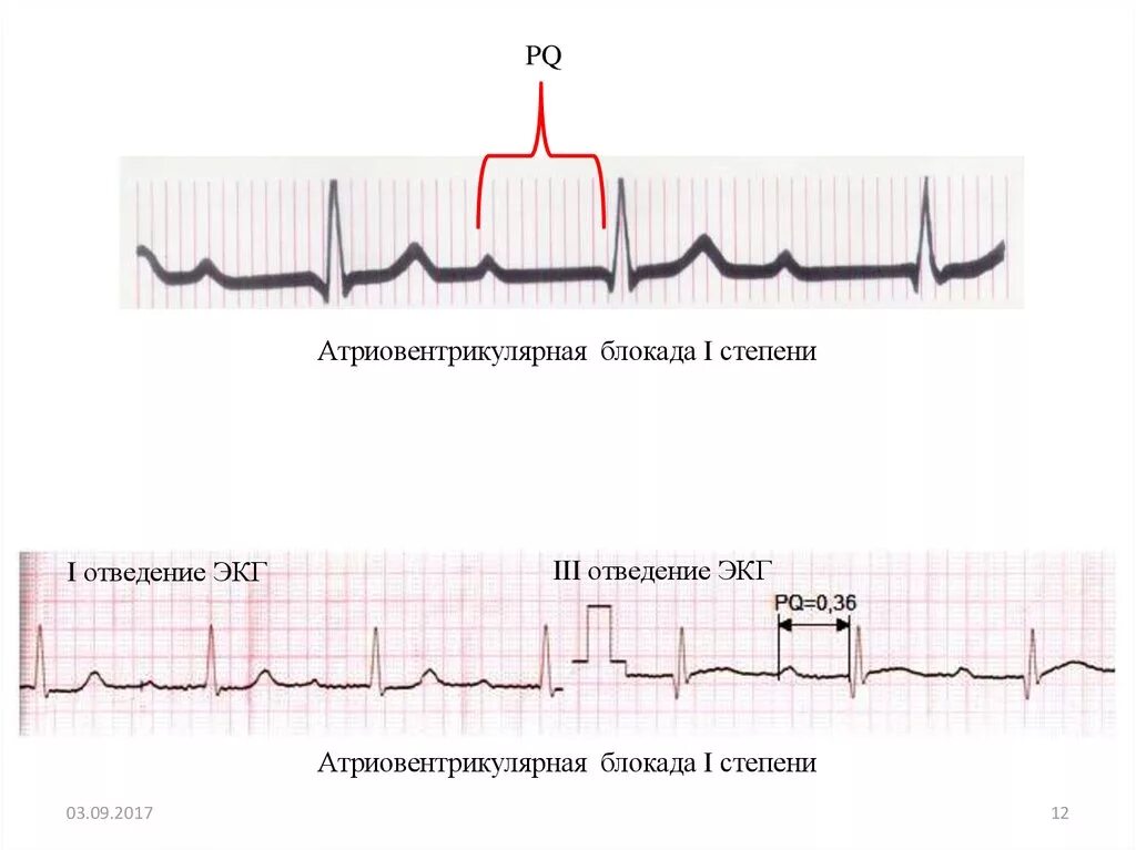 Блокада на первом. ЭКГ при АВ блокаде 1 степени. Атриовентрикулярная блокада 1 ЭКГ. АВ блокада 1 степени на ЭКГ. Атриовентрикулярная блокада на ЭКГ.
