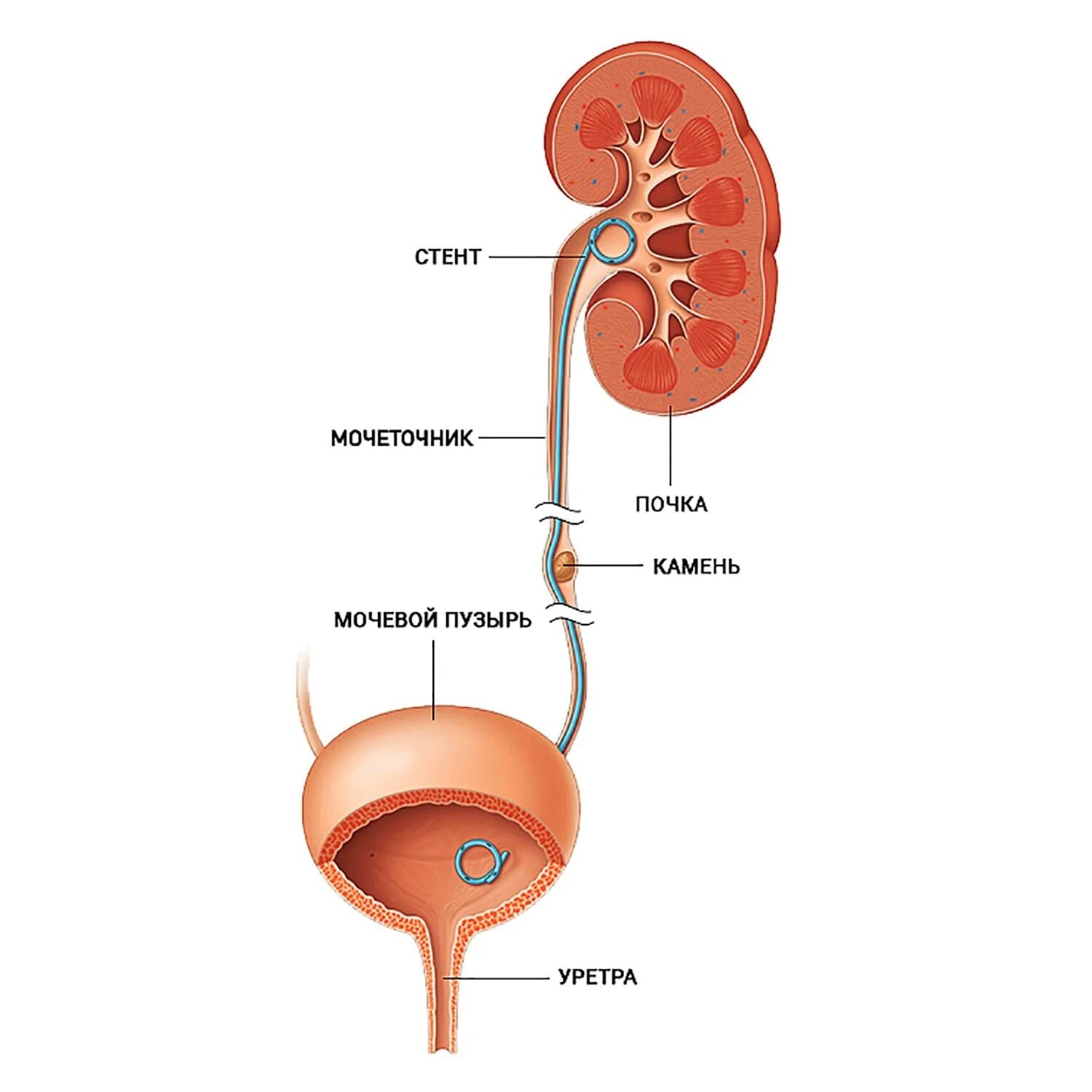 Камень в стенте мочеточника