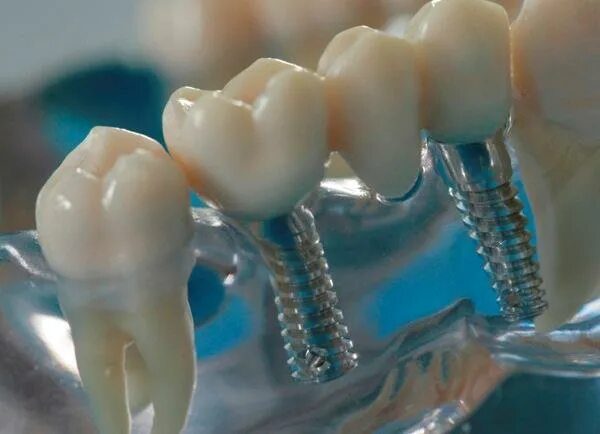 Через сколько можно вставлять зубы. Зубная коронка. Металлокерамические коронки на импланты.