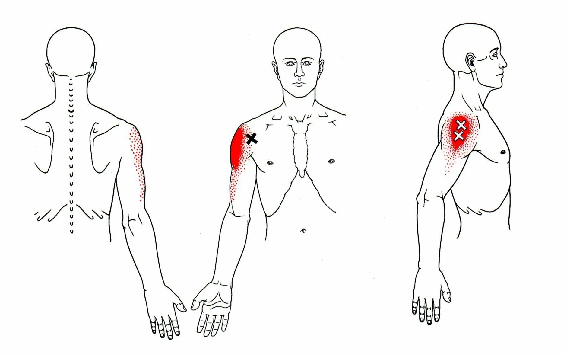 Тт1 триггерная точка. Триггерные точки схема атлас. Триггерные точки тт2. Карта триггерных точек с отраженными болями. Иррадиация в левую лопатку
