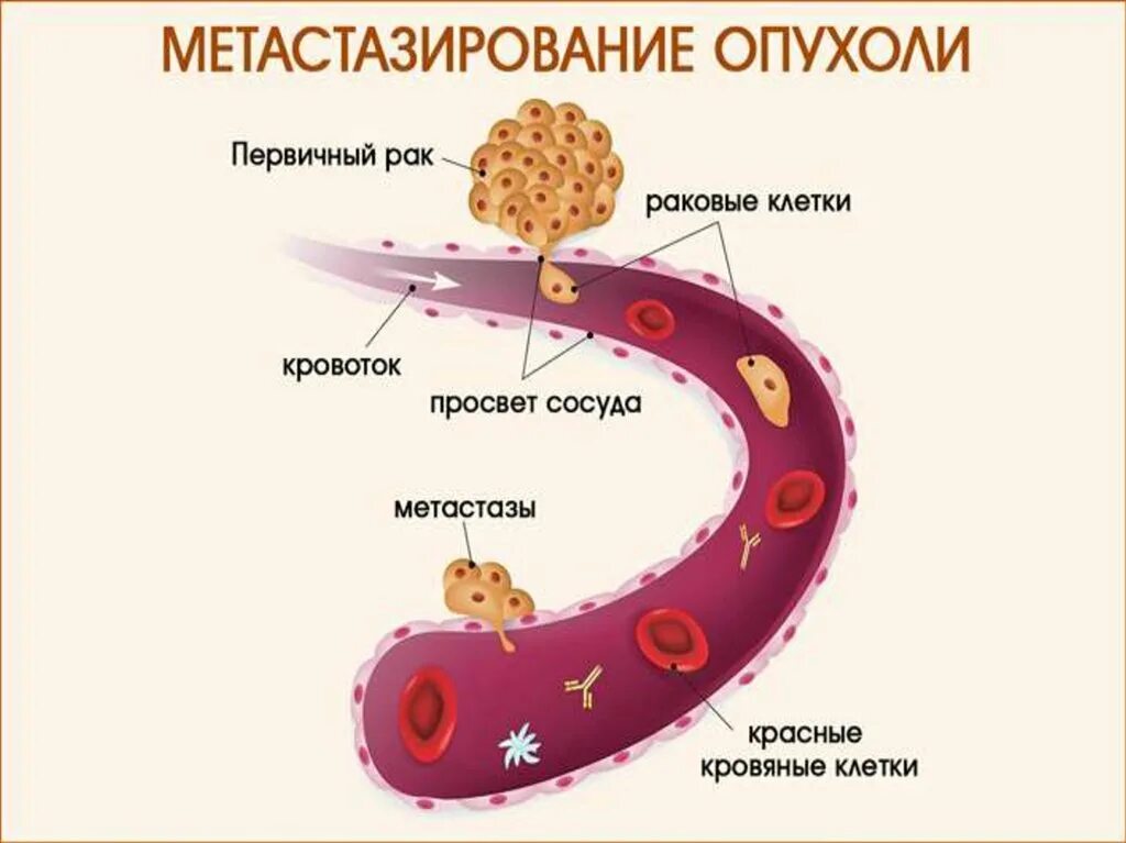 Что такое метастазы простыми словами