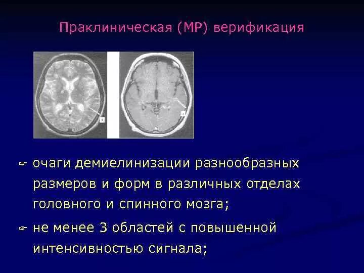 Демиелинизация головного. Демиелинизация головного мозга мрт. Демиелинизация спинного мозга мрт. Демиелинизирующее поражение спинного мозга мрт. Демиелинизирующие заболевания головного мозга.