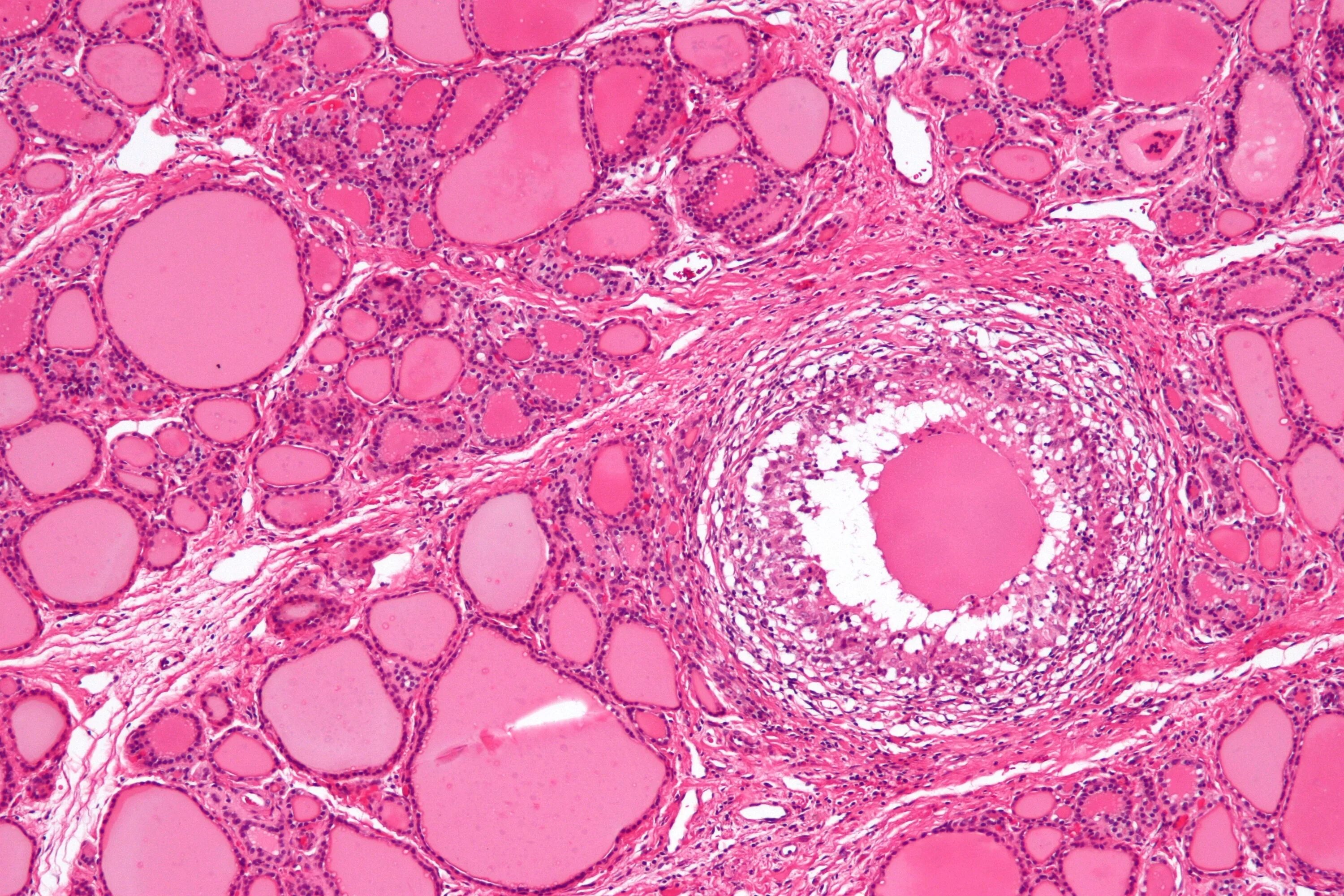 Подострый тиреоидит гистология. Тиреоидит де Кервена гистология. Тиреоидит щитовидной железы гистология. Фолликул тироцита