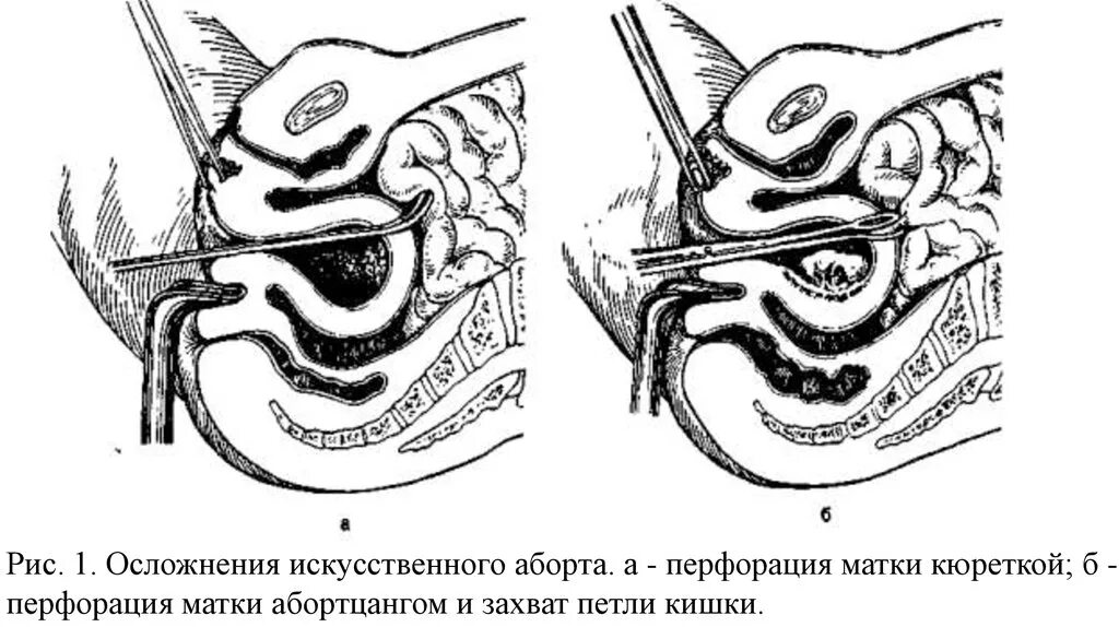 Выскабливание матки беременность. Перфорация матки гистероскопом. Перфорация матки клинические рекомендации. Перфорация матки гистероскопия. Перфорация матки после аборта.