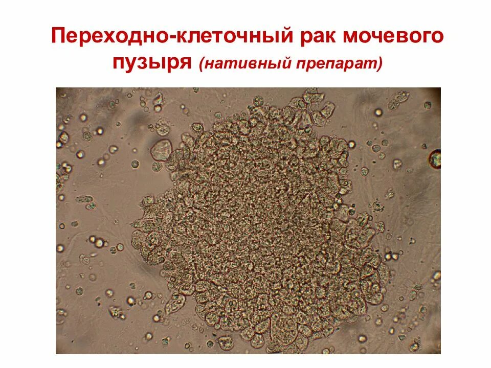 Микроскопия осадка мочи. Эритроциты в моче микроскопия. Микроскопия мочевого осадка. Переходно клеточные опухоли мочевого пузыря.