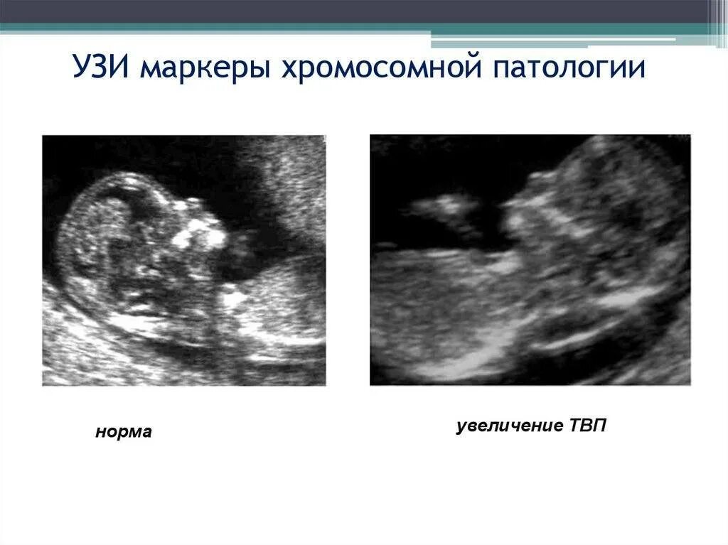 Плод на 12 недели УЗИ воротниковое пространство норма. Ультразвуковые маркеры хромосомных аномалий плода. Нормы 1 скрининга УЗИ толщина воротникового пространства. Скрининг беременности толщина воротникового пространства. Норма воротникового пространства в 13 недель