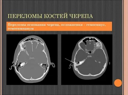 Сломано основание