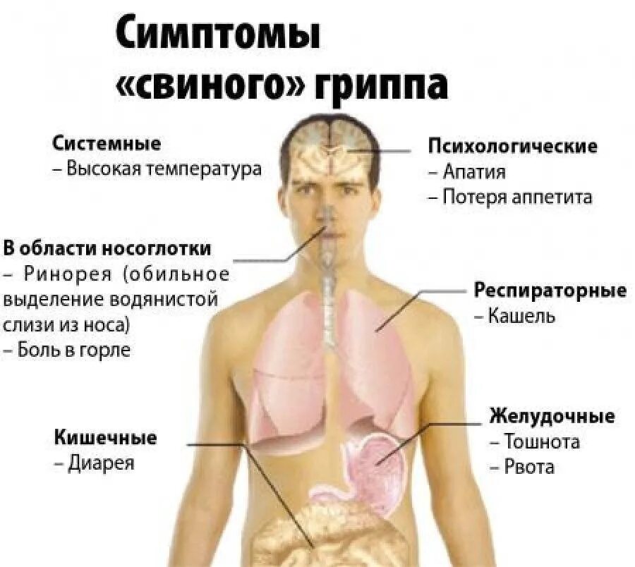 Подтвержденный гриппа. Свиной грипп. Свиной грипп симптомы. Признаки свиного гриппа. Симптомы гриппа свиной грипп.