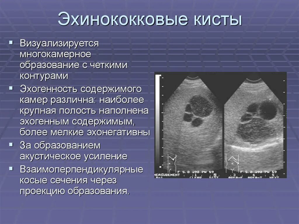 Кистозное образование печени. Эхинококковая киста селезенки на УЗИ. Паразитарная киста селезенки УЗИ. Паразитарная киста селезенки на кт. Кистозное образование селезенки.