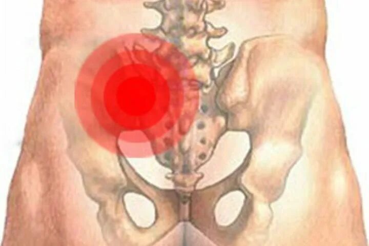 Сильная боль в подвздошной. Сакроилеит крестцово-подвздошного. Неспецифический сакроилеит. Сакроилеит крестцово-подвздошного сочленения рентген. Сакроилеит крестцово-подвздошного сочленения.