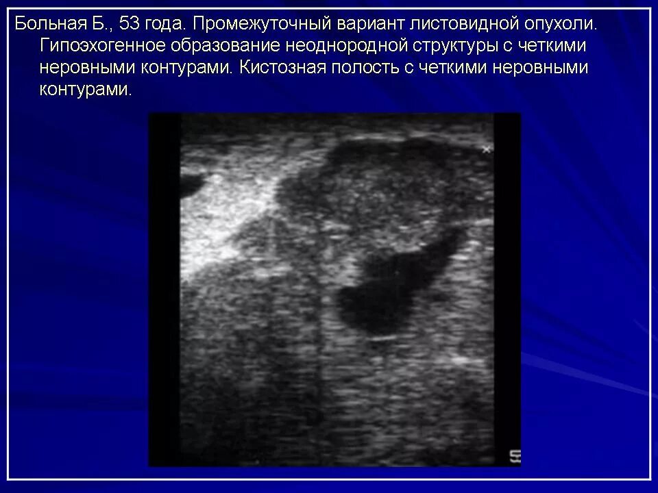 Гипоэхогенное неоднородное образование. Новообразования в молочной железе с четкими контурами. Гетерогенное образование в молочной железе. Изоэхогенное образование с четкими контурами.