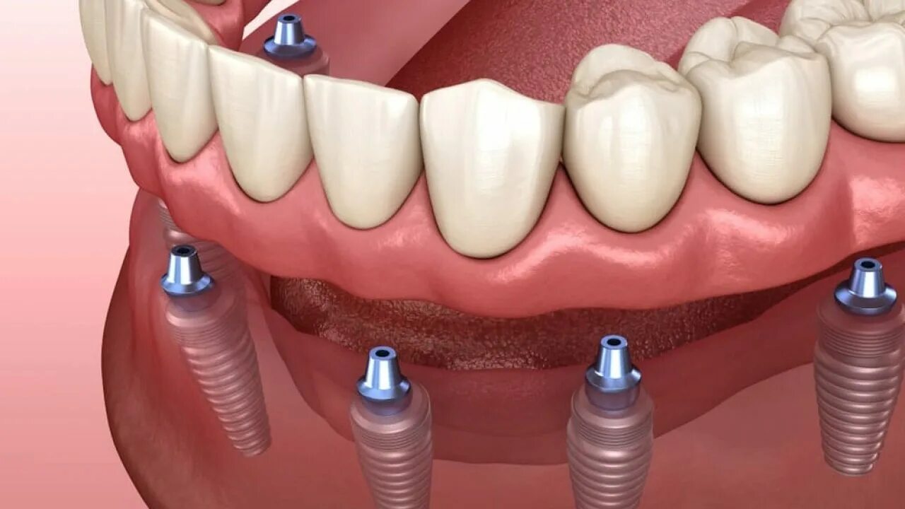 Что такое имплант. Зубной имплантат.