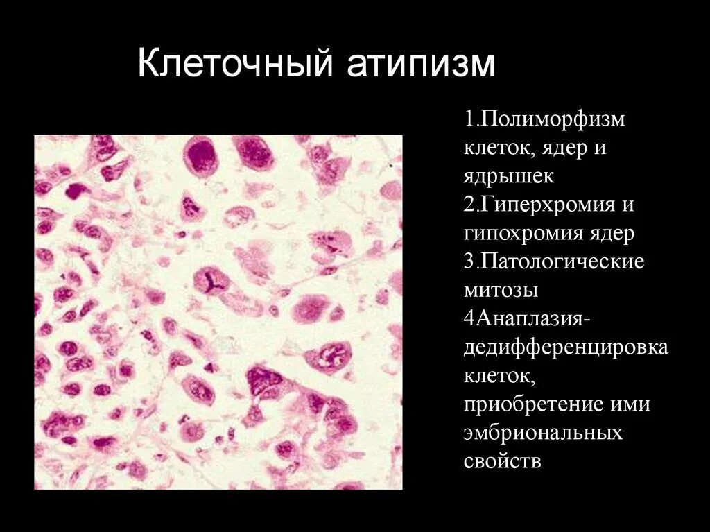 Клеточный полиморфизм. Полиморфизм клеток в онкологии. Полиморфизм и атипия клеток. Клетки с гиперхромными ядрами