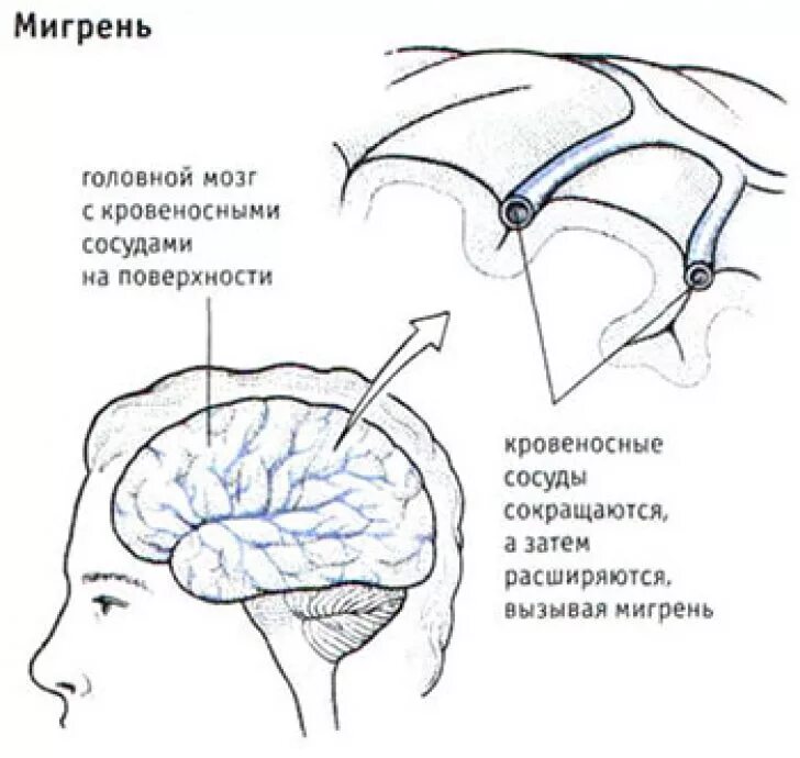 Мигрень. Мигрень головного мозга. Что такое мигрень головы. Мигрень и сосуды головного мозга. Мигрень симптомы и причины