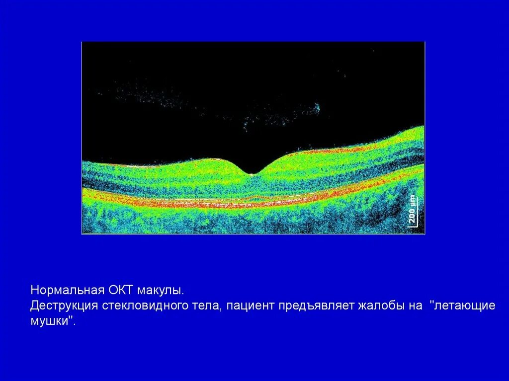 Окт изображение. Окт макулы. оптическая когерентная томография макулы. спектральной оптической когерентной томографии. нормальная окт.