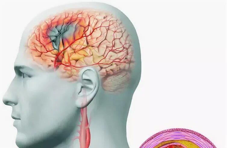 Помочь сосудам головы. Патологии артерий головного мозга. Поражение сосудов головного мозга. Поражение артерий головного мозга.