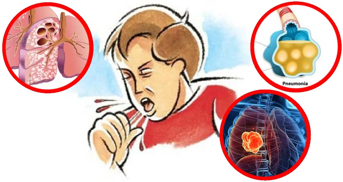 Кашель. Кровохоркаеие туберкулез. Человек кашляет туберкулез. Кашель с кровью что может быть