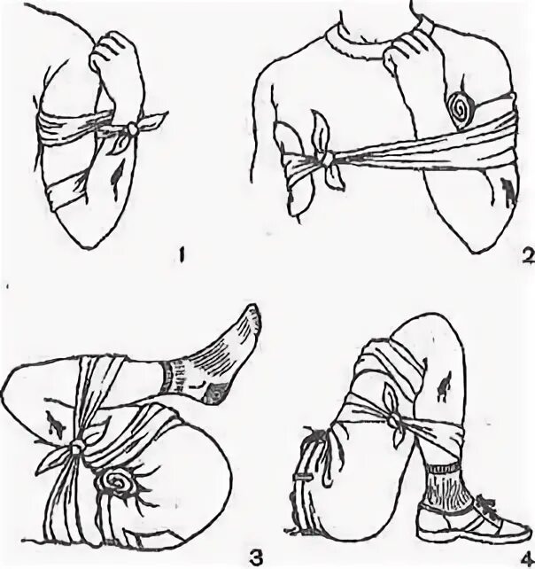 Способы наложения повязок при кровотечении. Остановка кровотечения косыночной повязки. Максимальное сгибание конечности. Повязка максимальное сгибание конечности. Сгибание конечности при кровотечении.