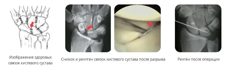 Ганглион лучезапястного сустава. Симптом повреждения сухожилия лучезапястного сустава. Перелом крючковидной кости кисти. Растяжение связок лучезапястного сустава симптомы. Перелом трехгранной кости запястья.