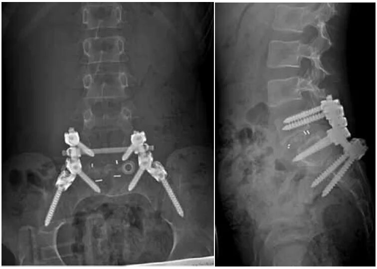Рентген крестцового отдела позвоночника подготовка. Перелом крестцового отдела позвоночника рентген. Рентген пояснично-крестцового отдела в 2 проекциях. Рентген поясничного отдела позвонка. Снимок рентгена пояснично крестцового отдела.