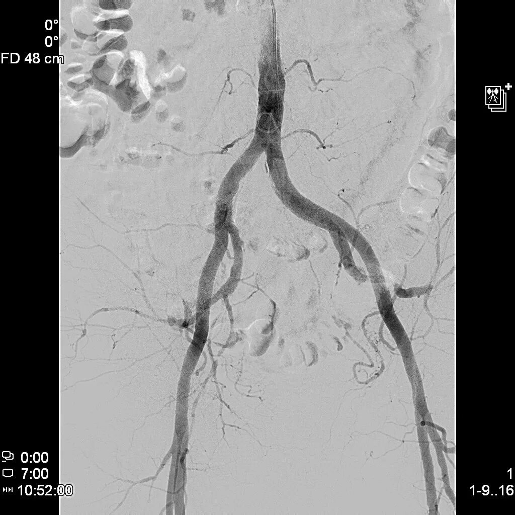 Контрастная ангиография сосудов нижних конечностей. Тромбоз артерии ангиография. КТАНГИОГРАММА подвздошных артерий. Атеросклероз артерий нижних конечностей ангиография. Тромбоз почечной артерии
