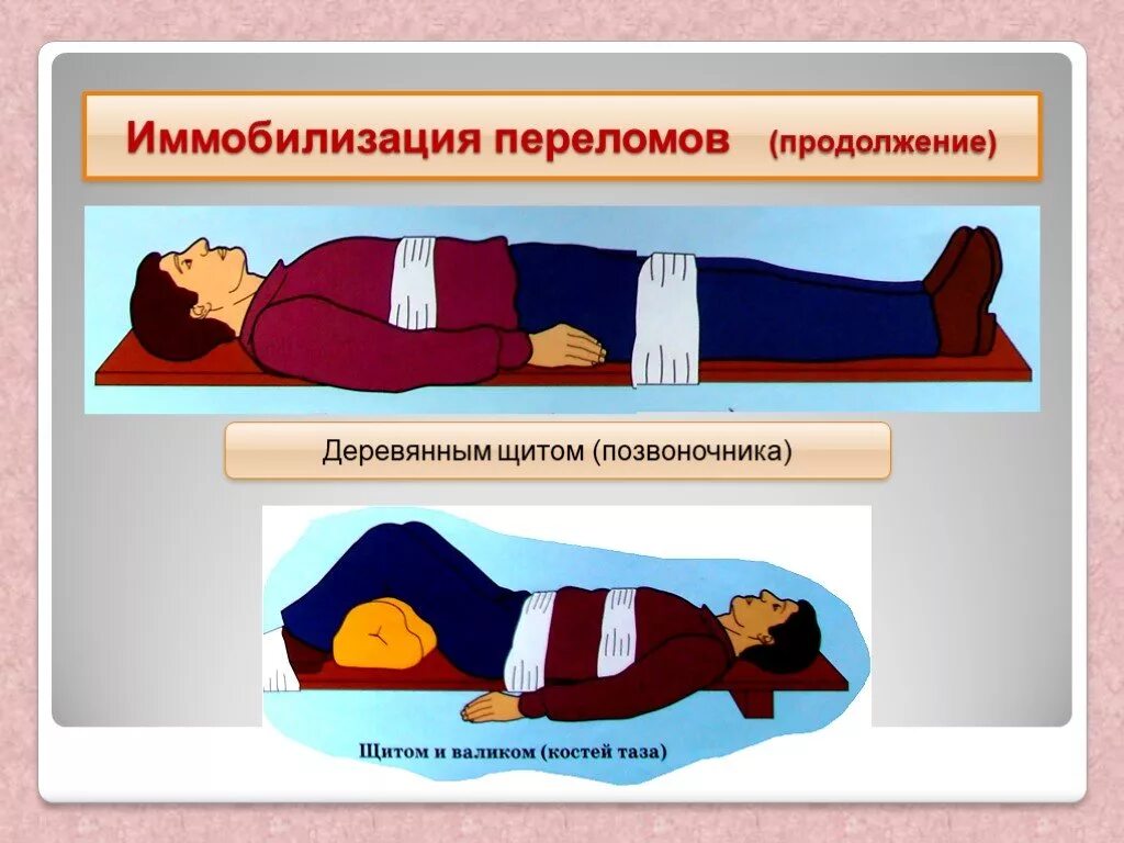 Транспортная иммобилизация пострадавшего с переломом костей таза. ПМП при переломе позвоночника ОБЖ. Первая помощь при переломах костей позвоночника. Иммобилизация при переломе позвоночника.