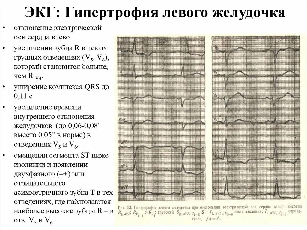 Диффузные изменения экг что это значит. ЭКГ- критерии гипертрофии лж. ЭКГ при гипертрофии миокарда правого желудочка. Гипертрофия левых отделов сердца на ЭКГ. Гипертрофия левого желудочка на ЭКГ.