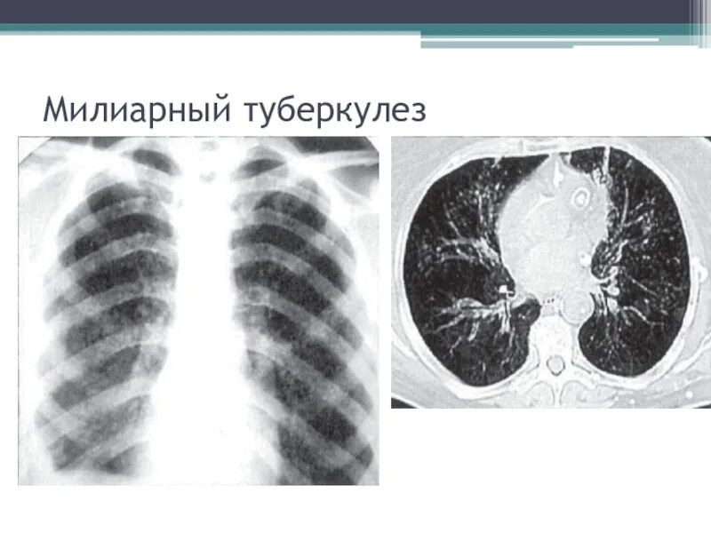 Острый диссеминированный туберкулез. Милиарный диссеминированный туберкулез. Острый милиарный диссеминированный туберкулез. Острый милиарный диссеминированный туберкулез клиника. Милиарный туберкулез легкого рентген.