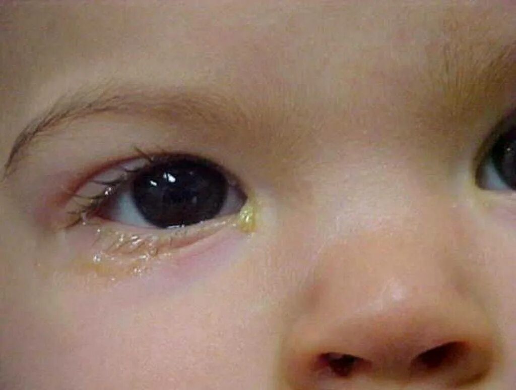 Профилактика глаз новорожденного. Хламидийный конъюнктивит у новорожденных. Гонобленорейный конъюнктивит. Гонококковый конъюнктивит новорожденных.